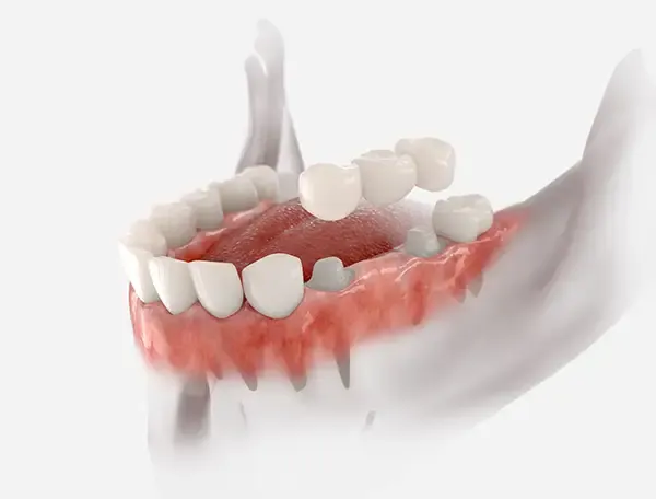 A transparent view of a jaw where a bridge is being placed over two teeth and the gap between them.