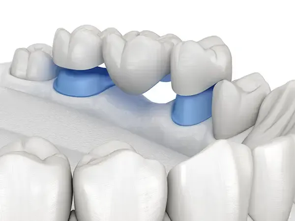 Close-up view of a dental bridge supported by two prepared teeth, illustrating the restoration process.