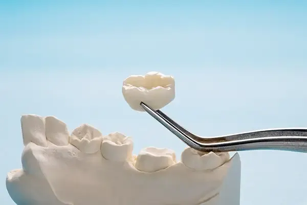 Ceramic dental crown held by tweezers above a dental model, showcasing precise restoration placement.