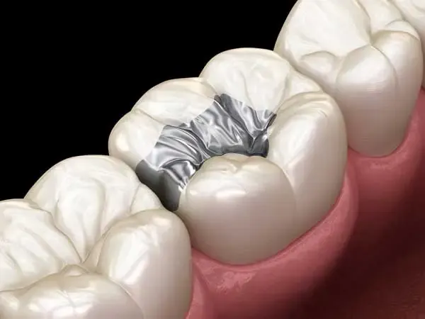 A close-up of a molar with an amalgam dental filling, showcasing a common material used in cavity restoration.