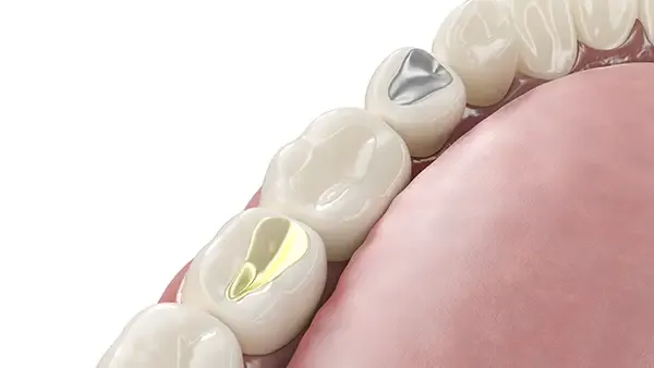 A close-up of molars with gold, amalgam, and composite fillings, emphasizing different materials available for cavity treatment.