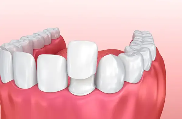 In-progress close-up of applying a dental veneer to a tooth, highlighting the transformation of a natural tooth.