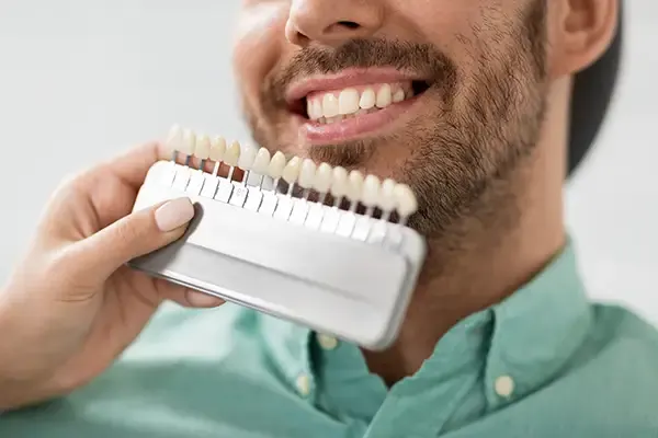 Close-up of a male patient’s teeth being matched to a dental veneer shade guide during a consultation.
