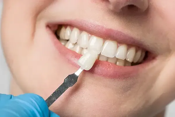 Dentist using a precise shade matching tool to select the ideal dental veneer for a smiling patient’s teeth.