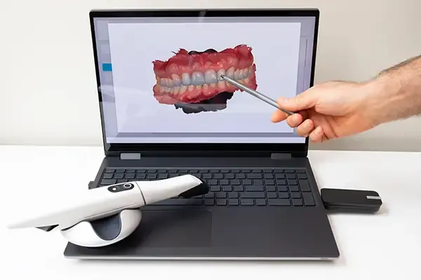 Close-up of a laptop screen showing a 3D model of teeth from a digital dental scan, alongside a handheld dental scanner on a desk.