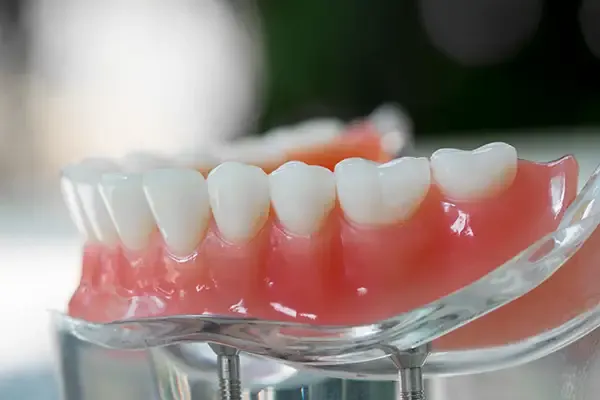 Close-up of an implant-supported denture model showing artificial teeth and metal implants for stability.