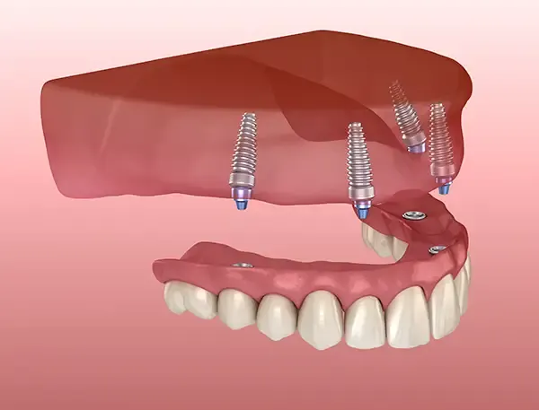 A dental implant-supported denture being secured into place for a stable and functional restoration.