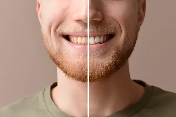 A before and after smile of a man showing the effectiveness of teeth whitening treatment.