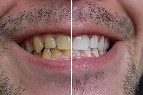 Close-up of a man's smile before and after undergoing a teeth whitening procedure.