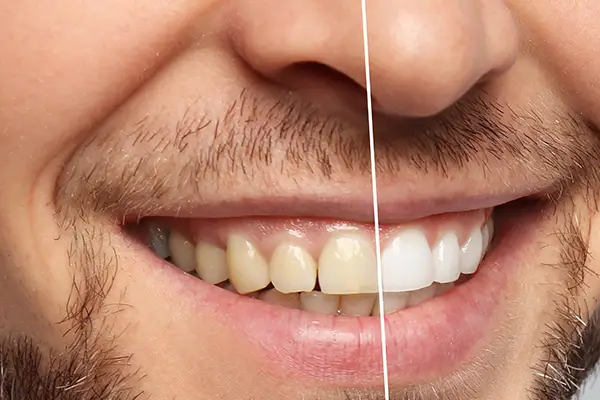 A man's smile showing stark differences before and after professional teeth whitening.